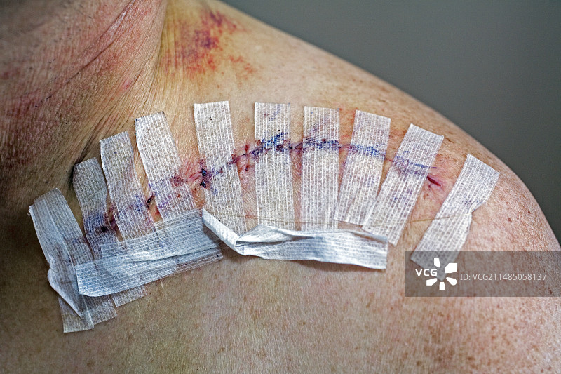 锁骨手术图片素材