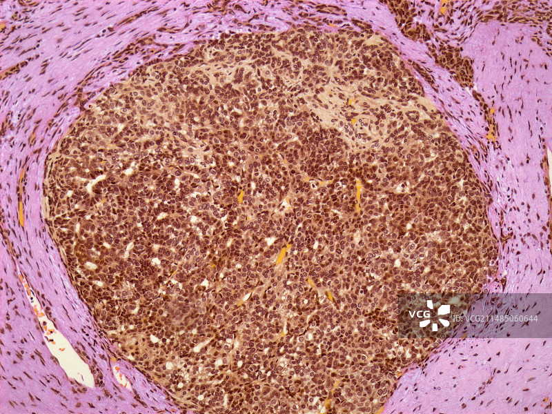 肝癌，光学显微镜照片图片素材