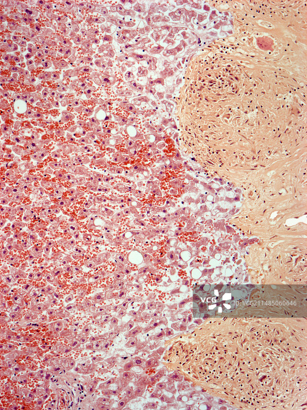 肝脏结节病，光学显微照片图片素材