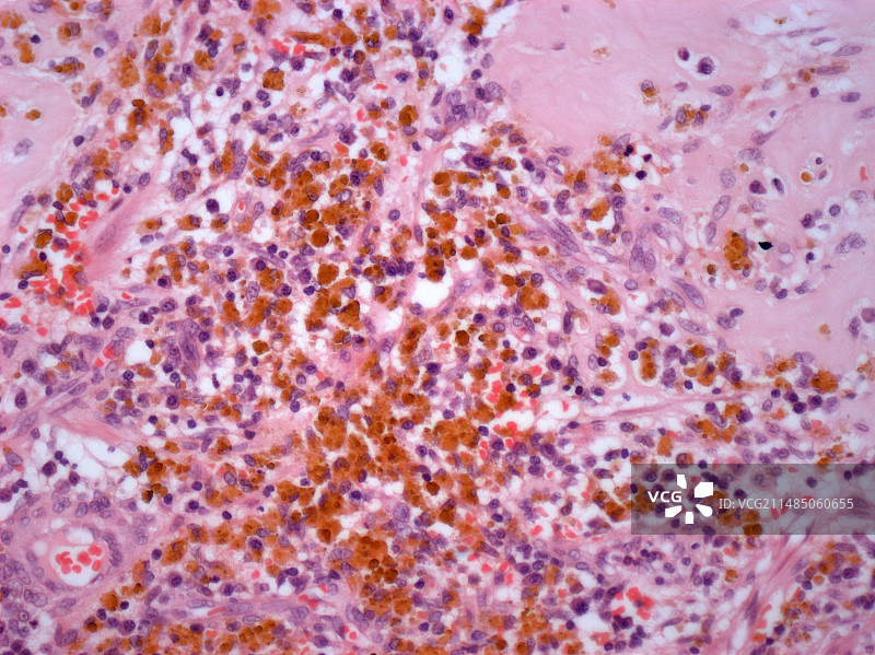 恶性黑色素瘤，光学显微照片图片素材