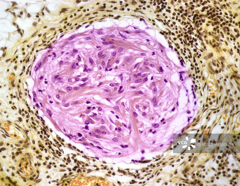 腹膜脑胶质瘤病显微照片图片素材