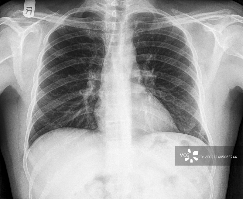 肋骨骨折图片素材