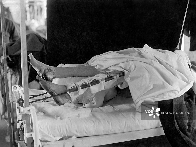 患有战壕足的受伤士兵，一战图片素材