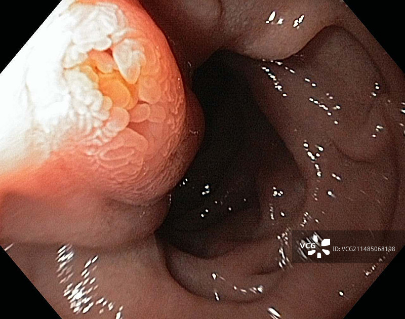 十二指肠大乳头内窥镜视图图片素材
