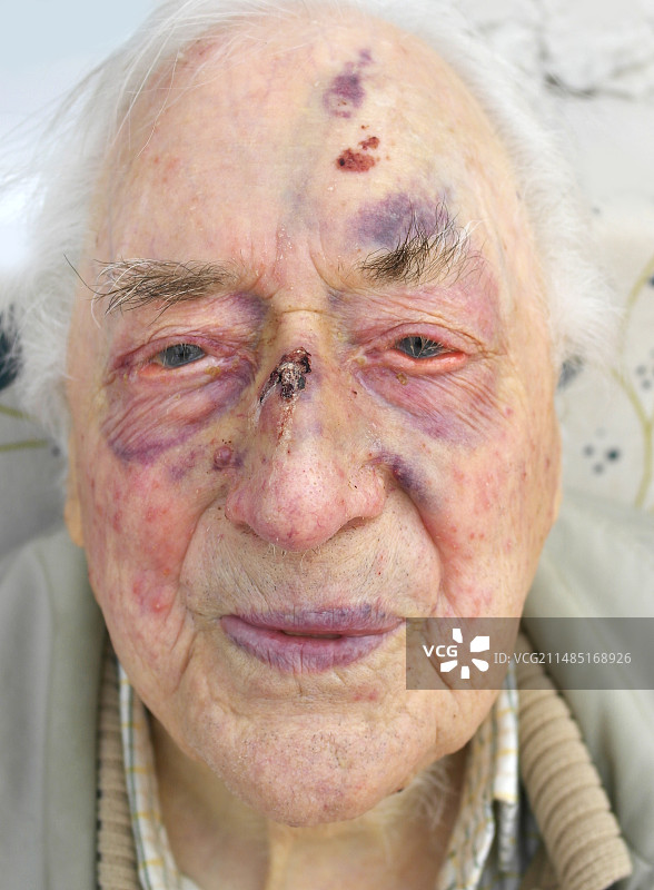 摔倒后的老年男性面部特写图片素材