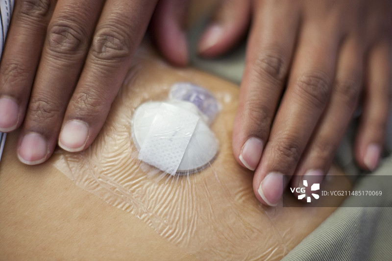 持续血糖监测图片素材