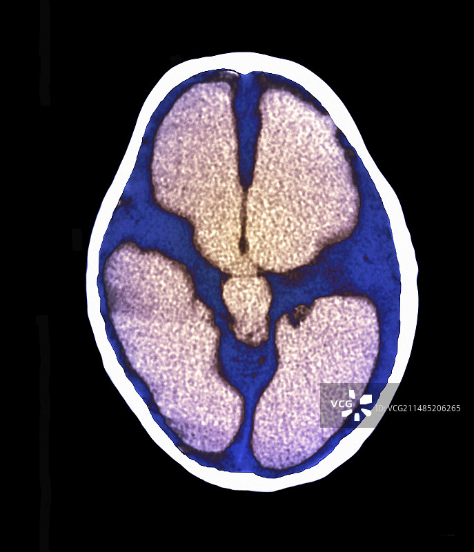 脑积水CT扫描图片素材