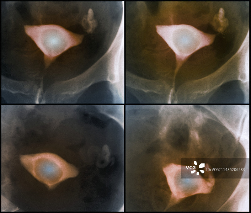 子宫内膜息肉X光片图片素材