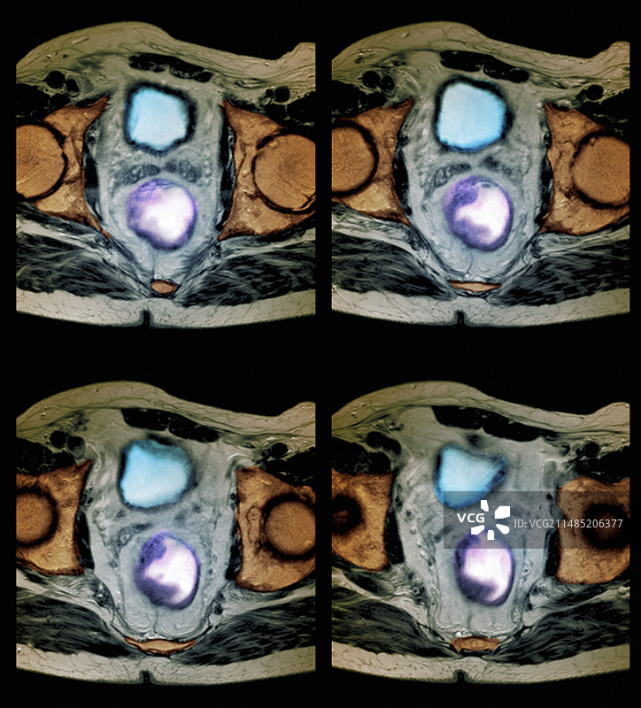 直肠癌核磁共振扫描图图片素材