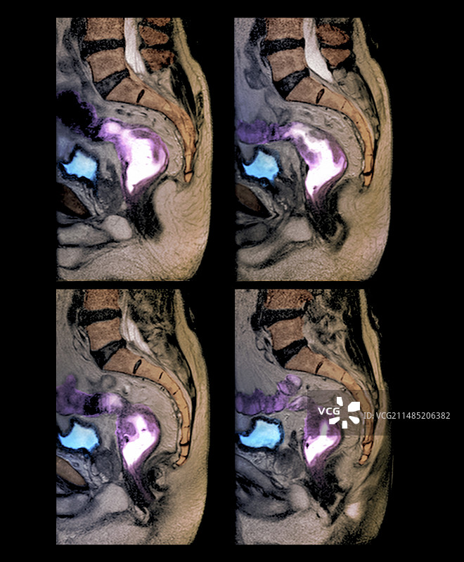 直肠癌核磁共振扫描图图片素材