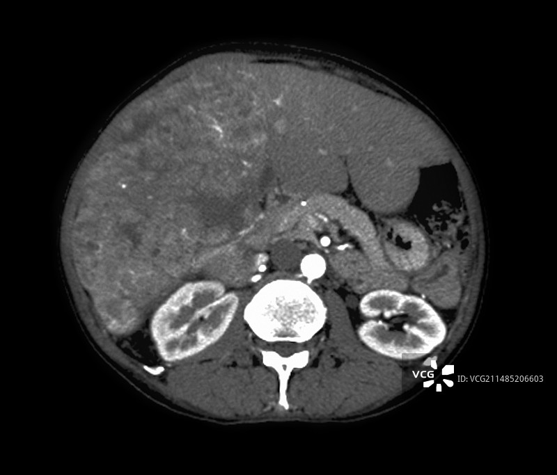 肝癌CT扫描图片素材