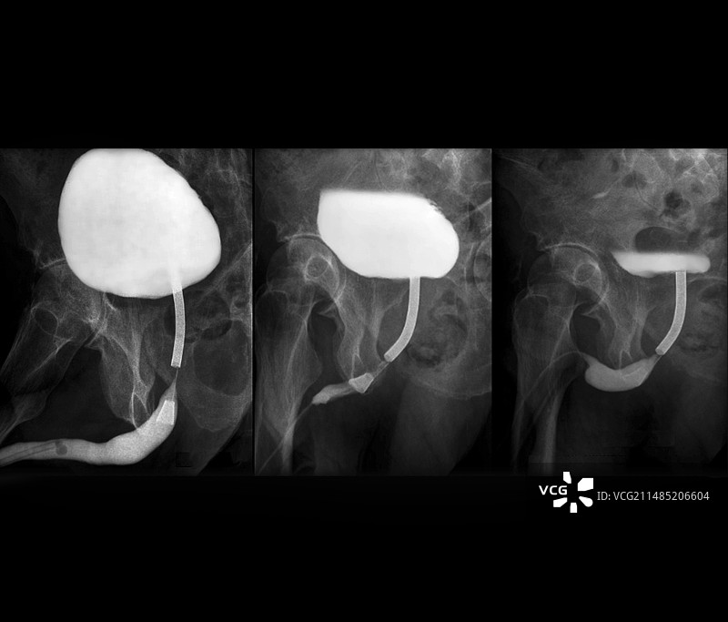 排泄性膀胱尿道造影X光片图片素材