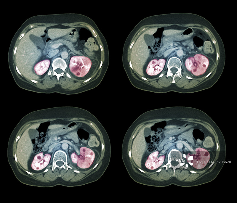肾脏感染CT扫描图片素材