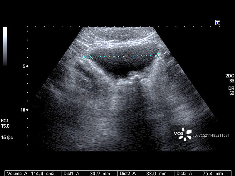 膀胱结石超声波扫描图片素材