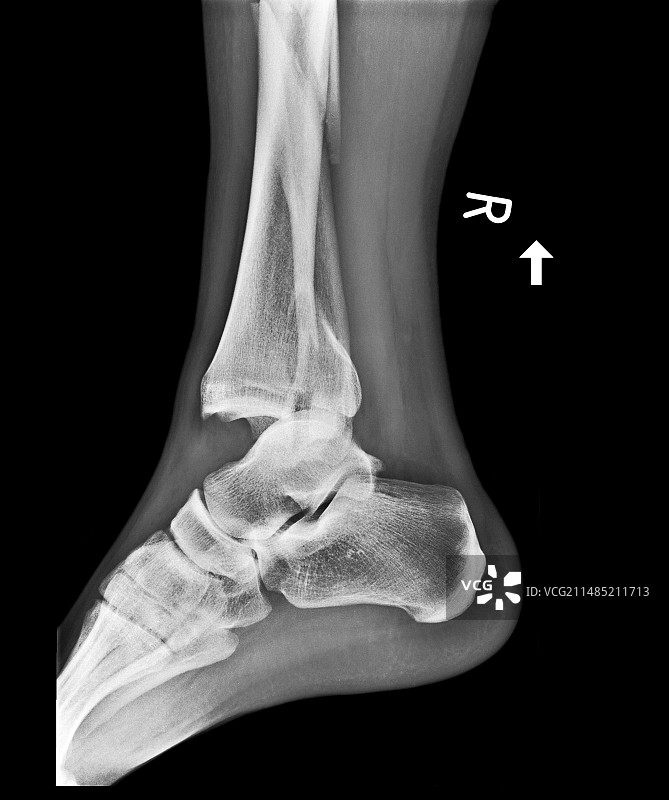 踝关节骨折脱位X光片图片素材