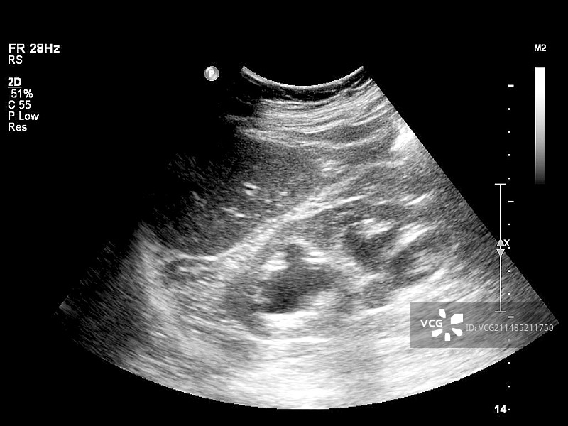 胆结石超声波扫描图片素材