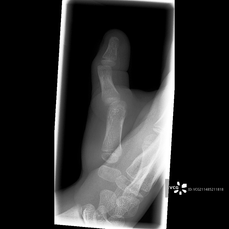 拇指脱臼，X光片图片素材