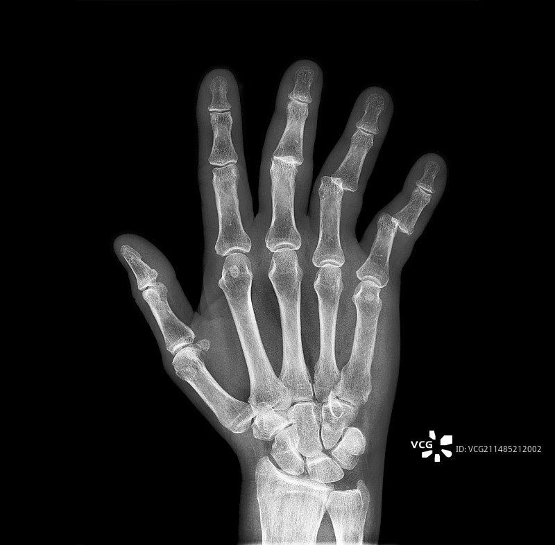 手指脱臼X光片图片素材