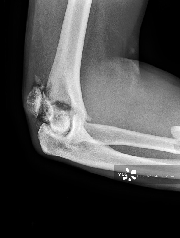 骨折的肘部X光片图片素材