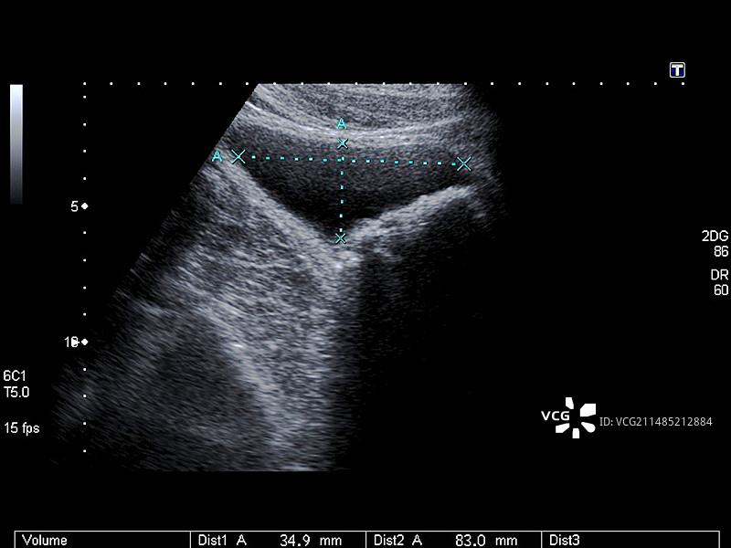 膀胱结石超声波扫描图片素材