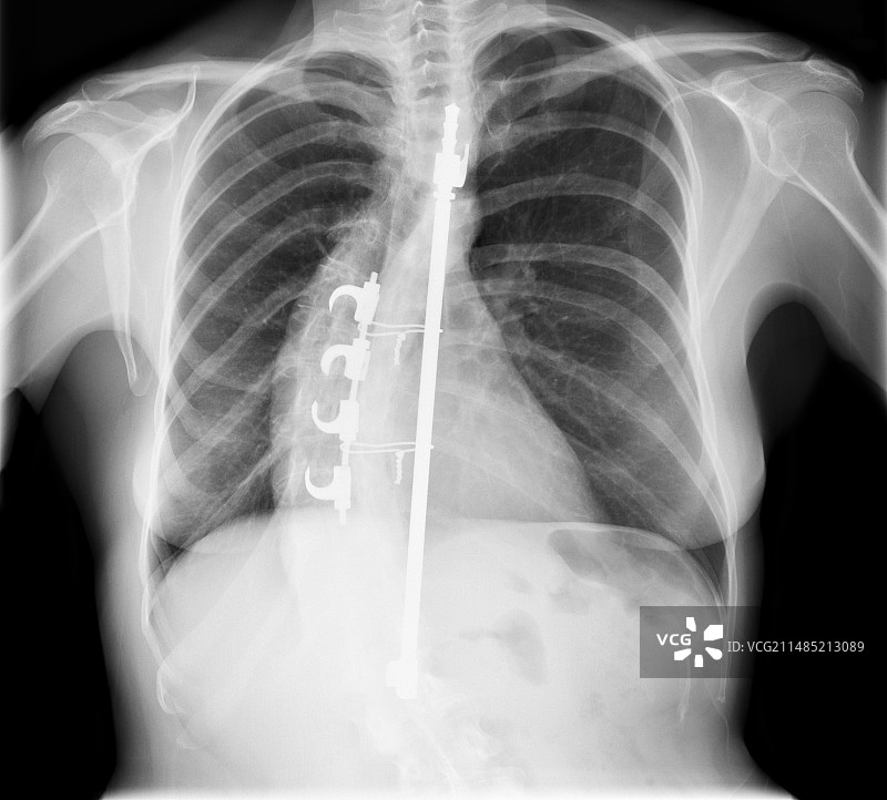 脊柱侧弯治疗X光片图片素材