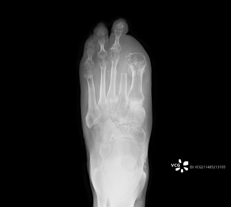 截肢的脚趾X光片图片素材