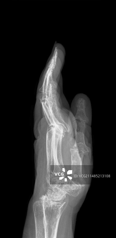 关节炎手部X光片图片素材
