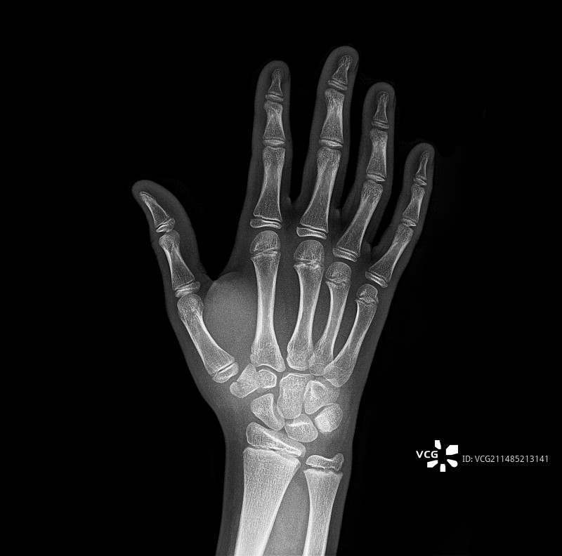 手腕骨折X光片图片素材