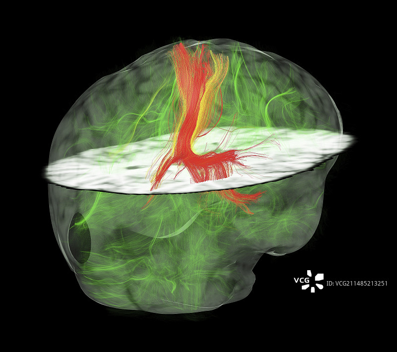 胶质母细胞瘤脑肿瘤DTI核磁共振扫描图片素材