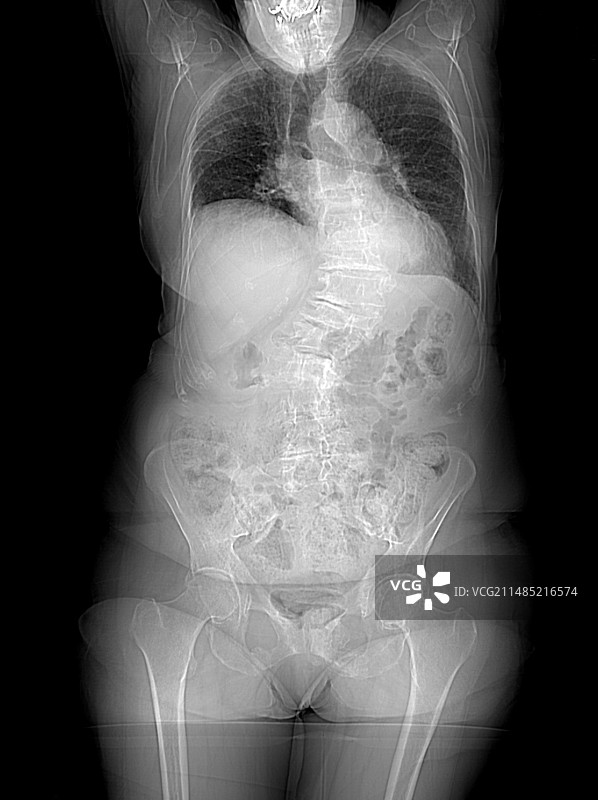 脊柱弯曲X光片图片素材
