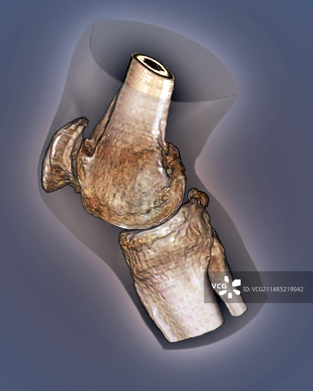 膝关节炎3D CT扫描图片素材