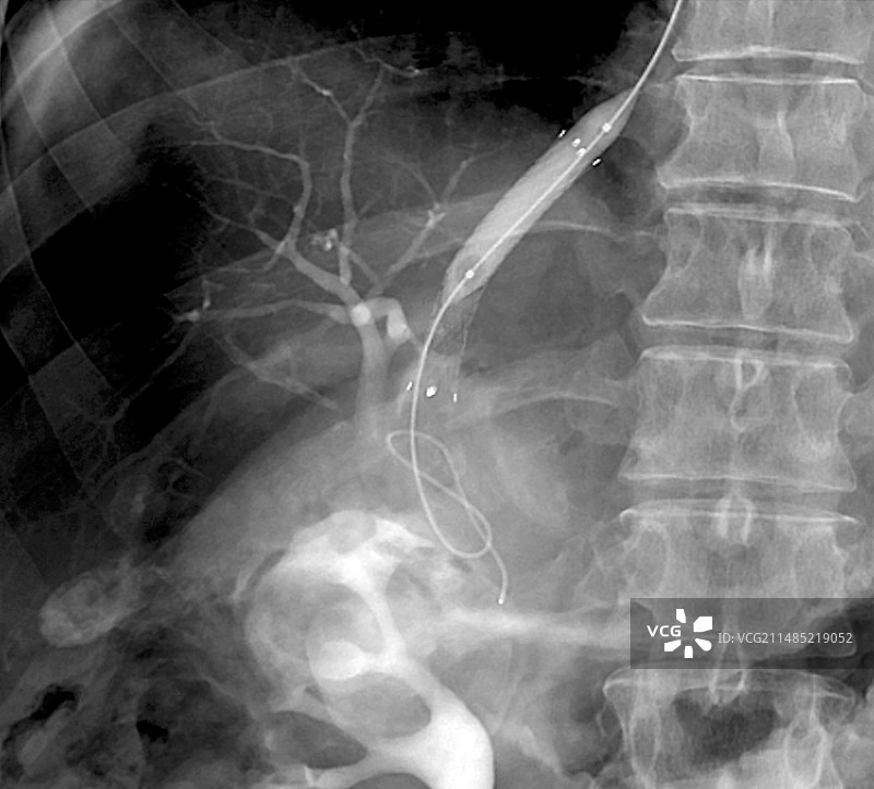 门静脉手术X光片图片素材