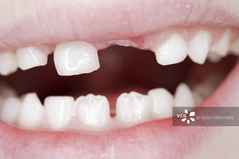 乳牙脱落图片素材