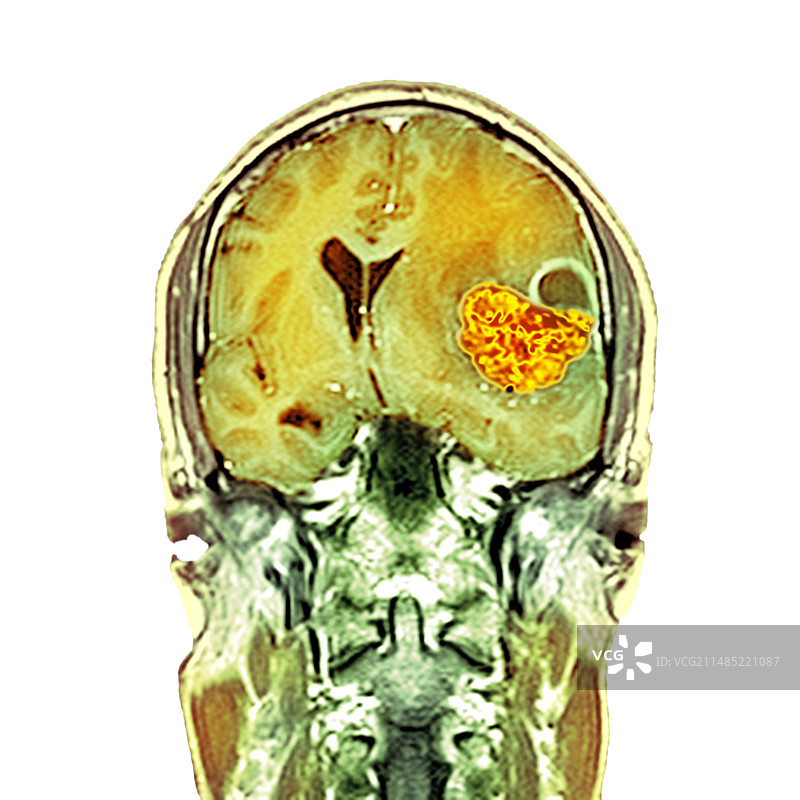 脑癌核磁共振扫描图片素材