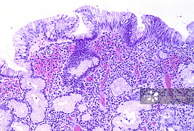 胃炎轻微显微照片图片素材