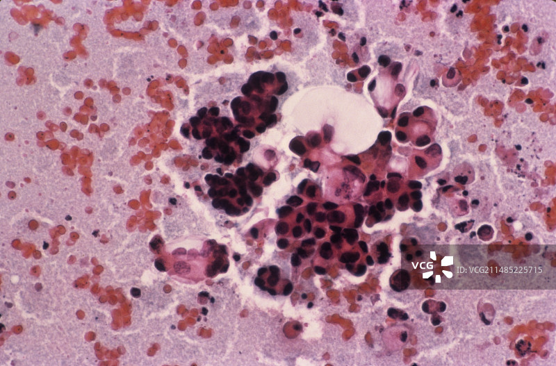 癌细胞，阴道涂片图片素材
