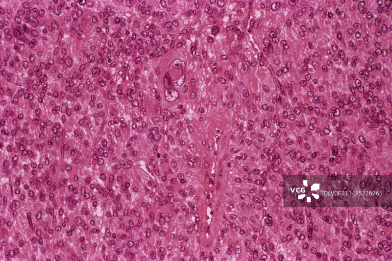 子宫肌瘤，光学显微照片图片素材