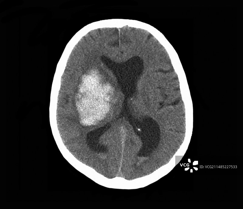 中风CT扫描图片素材