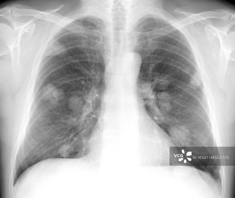 继发性肺癌X光片图片素材