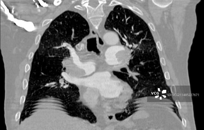 肺栓塞CT扫描图片素材