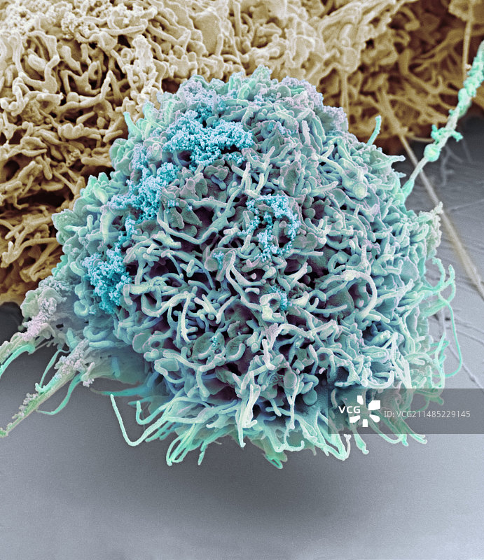 阴道癌细胞（扫描电镜）图片素材