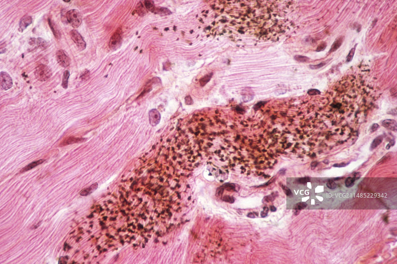 库欣综合征显微照片图片素材