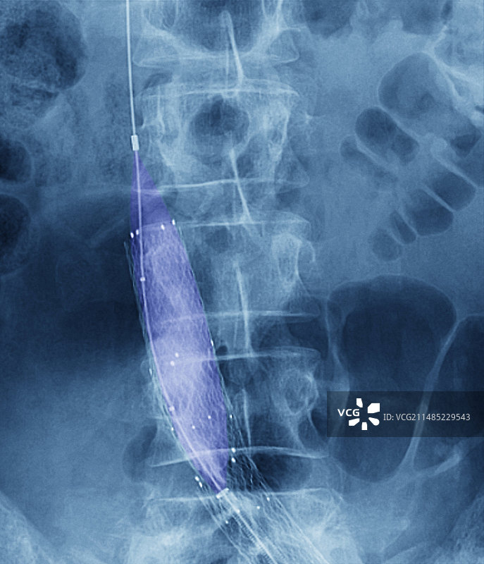 球囊血管成形术X光片图片素材