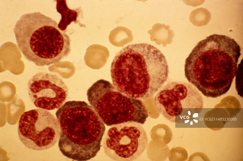 恶性贫血显微照片图片素材