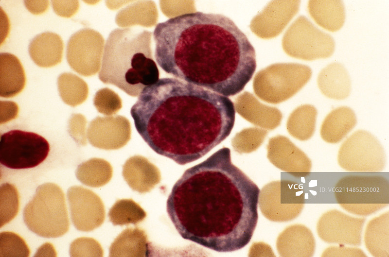 恶性贫血显微照片图片素材