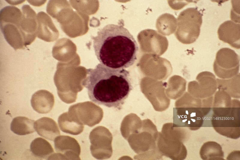 恶性组织细胞增生症显微照片图片素材