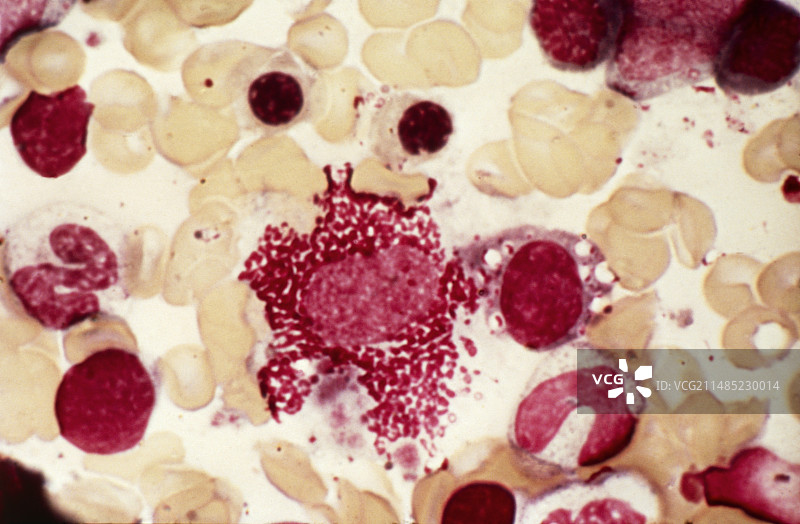 朗格汉斯细胞组织细胞增生症显微照片图片素材