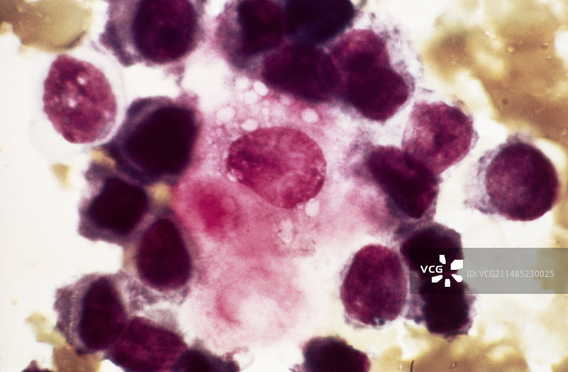 转移性乳腺癌，显微照片图片素材