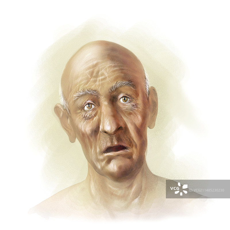 阿尔茨海默病艺术作品图片素材