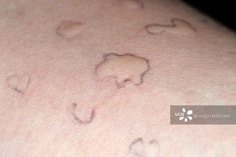 皮肤点刺过敏测试图片素材